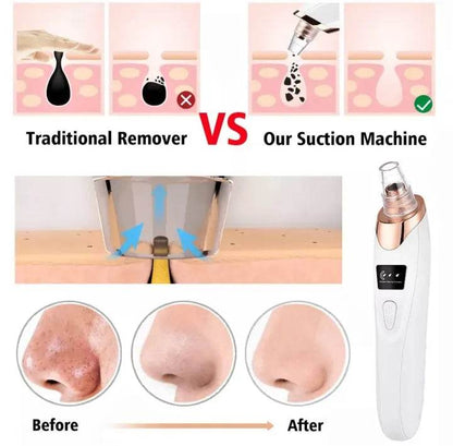 Acne Pore Cleaner & Black Head Remover - Vora