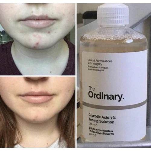 The Ordinary Glycolic Acid 7% Toning Solution - 240ml - Vora