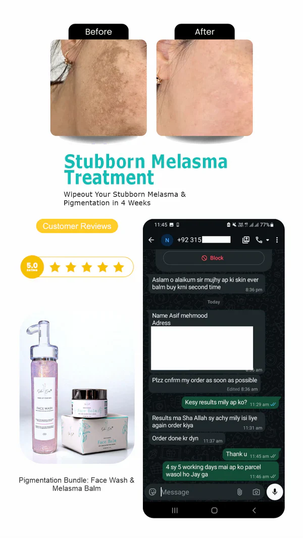 Face Balm For Melasma 50% off & free delivery