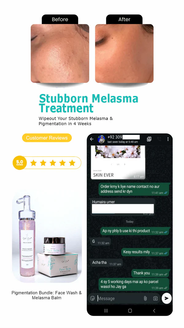 Face Balm For Melasma 50% off & free delivery